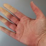 Red, White and Blue Extremities: Could You Have Raynaud’s?