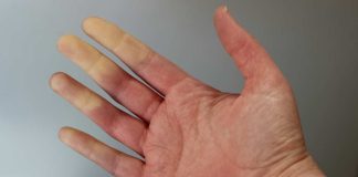Red, White and Blue Extremities: Could You Have Raynaud’s?