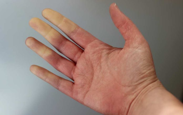 Red, White and Blue Extremities: Could You Have Raynaud’s?