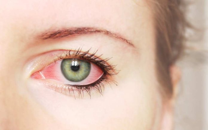7 Causes of Red Eyes Besides Pink Eye